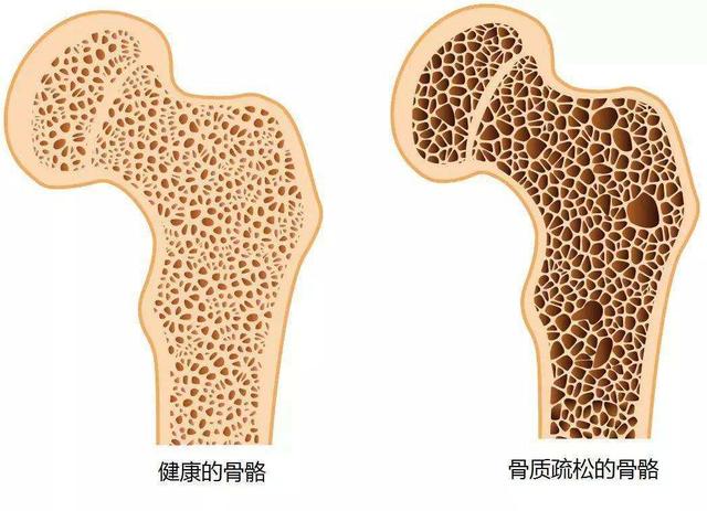 骨质疏松症分为局限型和弥漫型